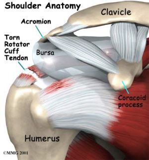 Rotator_Cuff_Tear
